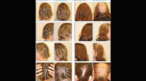 The main cause of hair loss in chemo is the medication taken in therapy. How Some Women Avoid Hair Loss During Chemotherapy Cnn
