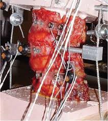 Anatomic Facet Replacement System Afrs Restoration Of Lumbar Segment Mechanics To Intact A Finite Element Study And In Vitro Cadaver Investigation Sciencedirect