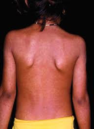 Desquamation (skin coming off in scales) psoriasiform (large white or silver flakes) pityriasiform (branny powdery scale) lichenoid (apparent scale is tightly adherent to the skin surface) keratotic (horny scale) exfoliation (peeling skin) maceration (moist peeling skin) verrucous (warty). Jaypeedigital Ebook Reader