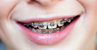 If there's a break in your archwire, you need to visit your orthodontist to remove the broken wire and how braces straighten teeth in children and adults. Do Braces Hurt What To Expect When You Get Braces
