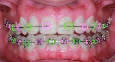 Maybe you would like to learn more about one of these? 28 Braces Ideas Braces Braces Colors Cute Braces