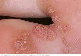 The recommendations for treating recalcitrant warts are unclear and there is a wide range of second line treatments available. Plantar Warts Symptoms And Causes Mayo Clinic