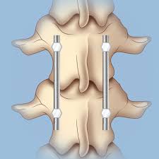 These compression fractures can occur in vertebrae anywhere in the spine, but they tend to occur most commonly in the upper back they rarely occur above the t7 level of the spine. Surgery For Spinal Compression Fractures Weill Cornell Brain And Spine Center