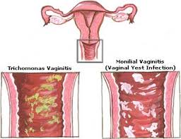 Yeast Infections Problem Yeast Infection While Pregnant Causes And Treatment