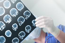 Faers and medical literature review. Alternative Techniques To Gadolinium Based Contrast Agents In Mr Neuroimaging Insights Into Imaging