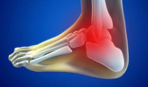 Tarsal Tunnel Syndrome Physiomax Wellness Burlington Physiotherapy