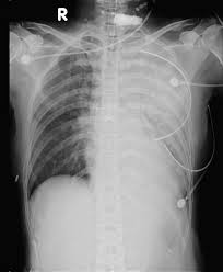 Image result for Pulmonary Contusion