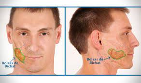 Regalamos mentóneras solo por inauguración sede. Bichectomia Para Estrechar Las Mejillas