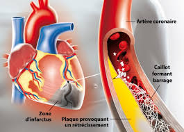 L'infarctus fait généralement référence à l'infarctus du myocarde, le muscle du cœur. Infarctus Du Myocarde Hopital Prive Clairval