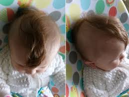 Even babies that don't lose all their hair, often have at least one bald spot at the back of their head during their first six months of living. My Daughters Hair Is Falling Out Leaving A Little Mohawk Mildlyinteresting