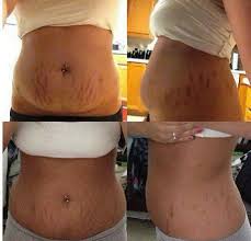I Love Making Women And Men Feel Better About Themselves Contact Me I Will Personally Help You Find Produc Stretch Mark Cream Stretch Marks Crazy Wrap Thing