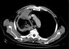 You may still be evicted for violating your lease by persistently and unreasonably engaging in behavior that Pneumonia In Immunocompromised Patients Overview Causes Of Pneumonia Hiv Aids
