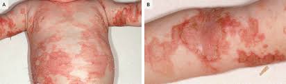Image result for Zinc Deficiency