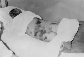 External factors may involve mechanical trauma (physical damage to the body which causes cellular breakdown), damage to blood vessels (which may disrupt blood supply to associated tissue), and ischemia. Crimean Congo Hemorrhagic Fever Wikipedia