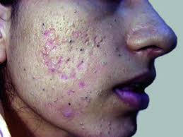 Acne may be a huge emotional stressor for adolescents who may withdraw, using the. Acne Vulgaris Dermatologic Disorders Msd Manual Professional Edition