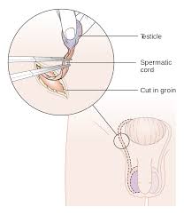What would cause 3 marble sized lumps in a male's groin area? Orchiectomy Wikipedia
