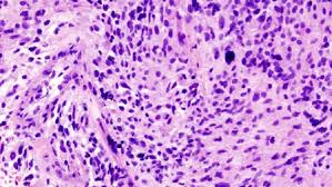 In general, brain tumors are more common among older people, but statistics even show an increase in brain tumors in kids. A History Of The Classification Of Glioma Brain Tumors