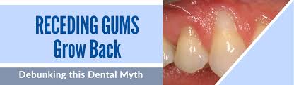 One day, my mom came out from her dentist, who informed her she had an incurable disease known as gingivitis, meaning that her gums were shrinking in size, bleeding easily. Receding Gums Grow Back Debunking This Dental Myth