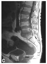 Image result for Spinal Infection