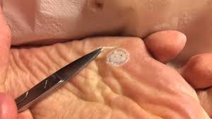 In order for warts to disappear, you need to salicylic alcohol is a solution of salicylic acid on an alcohol basis. Removal Of Foot Plantar Wart With Acid Part 2 3 Youtube