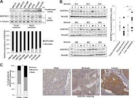 There is no sign that the cancer has spread outside of the colon or rectum. Sostdc1 Promotes Invasion And Liver Metastasis In Colorectal Cancer Via Interaction With Alcam Cd166 Oncogene