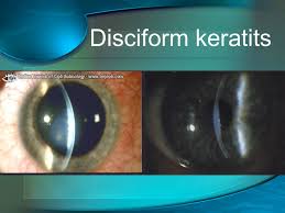 Herpes simplex keratitis is caused by recurrent infection of the cornea by herpes simplex virus (hsv). Herpetic Eye Disease Study Heds Presented By Ppt Video Online Download
