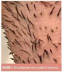 It's best to use a gentle scrub and exfoliate the treated area to help promote shedding. Folliculitis Induced By Laser Hair Removal Proposed Mechanism And Treatment Jcad The Journal Of Clinical And Aesthetic Dermatology