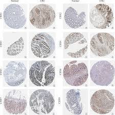The dark blue ribbons are used for child abuse awareness and colon cancer. Expression And Prognostic Significance Of Cbx2 In Colorectal Cancer Database Mining For Cbx Family Members In Malignancies And Vitro Analyses Cancer Cell International Full Text