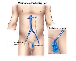 Image result for Varicocele