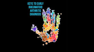 Keys To Early Rheumatoid Arthritis Diagnosis Chicago Arthritis And Regenerative Medicine