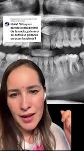 Extraccion De Dientes Supernumerarios