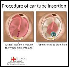 Procedure Of Ear Tube Insertion Ear Tubes Ear Phone Ring