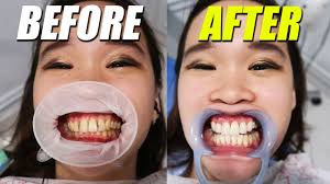 Kami sarankan anda buat panggilan dan temujanji terlebih dahulu untuk mendapatkan maklumat lebih lanjut tentang harga veneer gigi di klinik kerajaan malaysia. Pengalaman Pertama Veneer Gigi Youtube