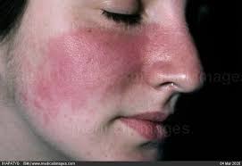Image result for Photodermatitis