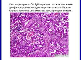 Начинается с общих симптомов (слабость, миалгии и. Ishemicheskaya Bolezn Kishechnika Zabolevanie Proyavlyayusheesya Razlichnymi Formami
