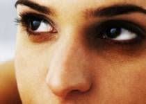 Goz Alti Morluklari Nedenleri Dark Circles Under Eyes Dark Circles Dark Circles Treatment