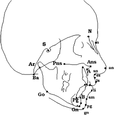 A Cephalometric Intercentre Comparison Of Patients With Unilateral Cleft Lip And Palate At 5 And 10 Years Of Age Ortodoncia Dentistas Odontologia