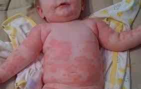 Top 3 Symptoms Of Wheat Allergy In Baby