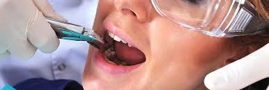 Tooth Extractions Aurora IL - Simple & Surgical Dental Extractions