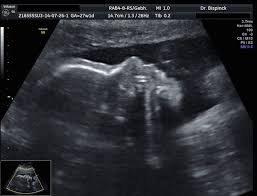 Der ultraschall hilft ärzten zu erkennen, ob die schwangerschaft gut verläuft und sich das baby normal entwickelt. Ultraschall In Der Schwangerschaft Frauenarztpraxis Dusseldorf