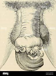 Image result for cornu cutaneum)