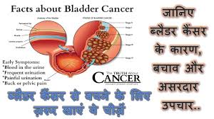 After a bit of urine is already stored, the resulting pressure is enough to trigger the urge to urinate and free up the bladder as a response. Foods To Prevent Bladder Cancer Bladder Cancer Urinary Bladder Cancer Bladder Infection Youtube