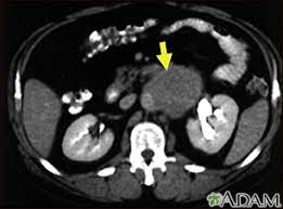 This ct scan of the upper abdomen shows multiple tumors in the liver and spleen that have spread (metastasized) from an original intestinal cancer (carcinoma). Abdominal Ct Scan Information Mount Sinai New York