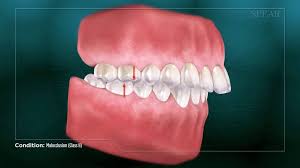 6 is there a surgery to correct overbites? Overjet Overbite In Adult Teeth Causes Orthodontic Treatments
