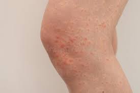 Image result for allergy rash on the legs