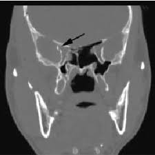 The vascular structures of three of them were injected with latex. Pdf Traumatic Superior Orbital Fissure Syndrome Current Management