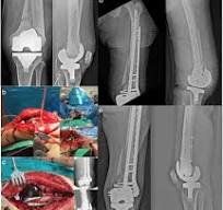 Double fixation for complex distal femoral fractures in ...