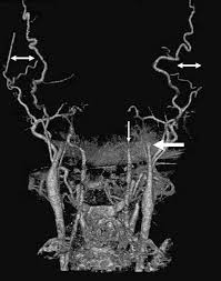 Cumplimiento de unos prerrequisitos 2. Diagnostico De Muerte Encefalica Mediante Tomografia Computarizada Multicorte Angio Tc Y Perfusion Cerebral