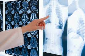 Benefits For Degenerative Disc Disease