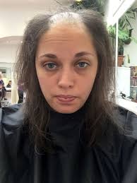 Masalah keguguran rambut lebih kerap dikaitkan dengan lelaki kerana hormon testosterone. Punca Rambut Gugur Di Usia Muda Vitamin Ummi Zara Pakar Kesihatan Anda